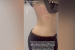Анна Седокова показала тело с сыпью и объяснила причину недуга
